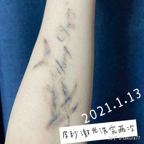 纹身洗掉照片,见证美丽重生